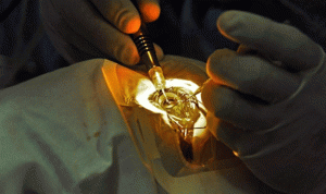أول عملية جراحية ناجحة داخل العين باستخدام روبوت