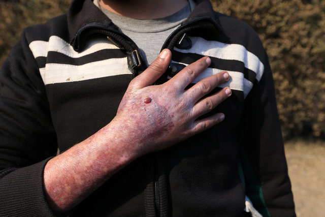 Sirhan Awwad shows his injuries after he tried to help remove a rocket fired by Islamic State that landed and exploded in Qayyara, Iraq, November 12, 2016. REUTERS/Air Jalal