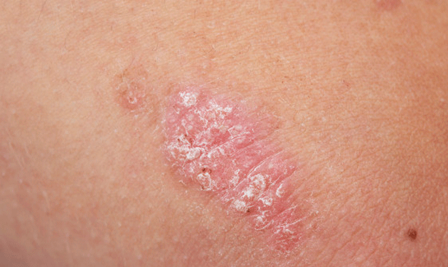 psoriasis