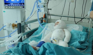 طفلة سورية نزحت 7 مرات ثم احترقت في مخيم