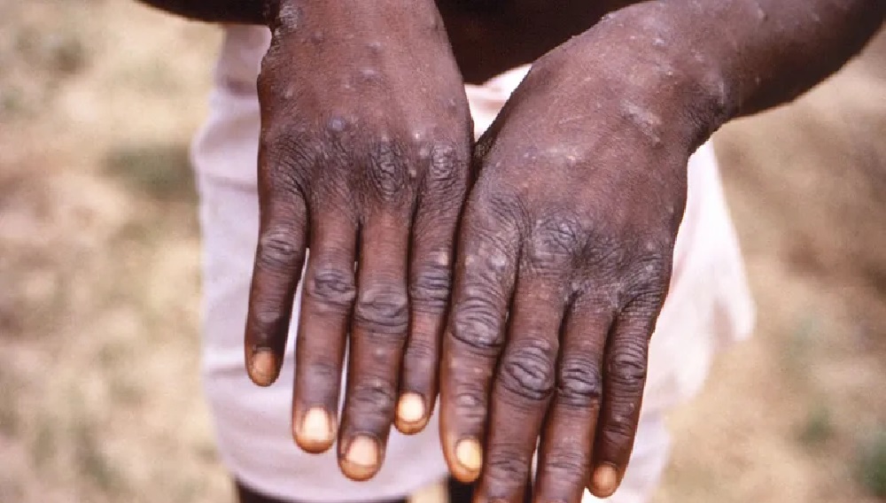 السودان: تسجيل 5 إصابات جديدة بجدري القردة
