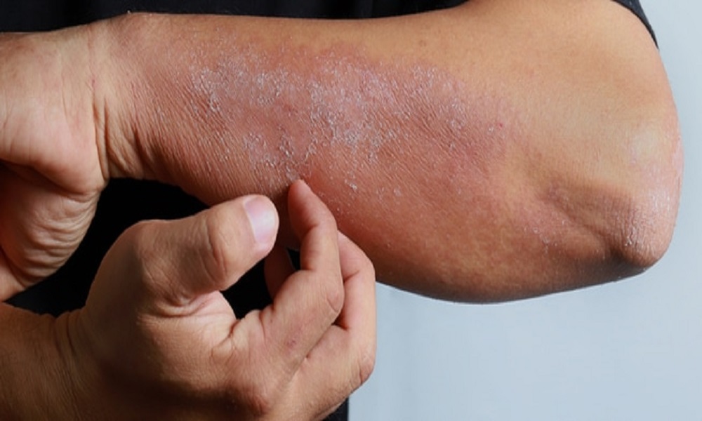 الولايات المتحدة تسجل أول إصابتين بمرض جلدي “خطير”