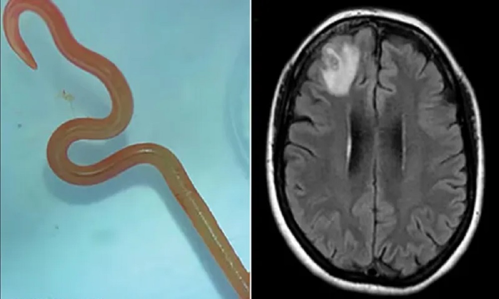 اكتشاف طبي نادر… دودة “ثعبان” في دماغ مريضة!