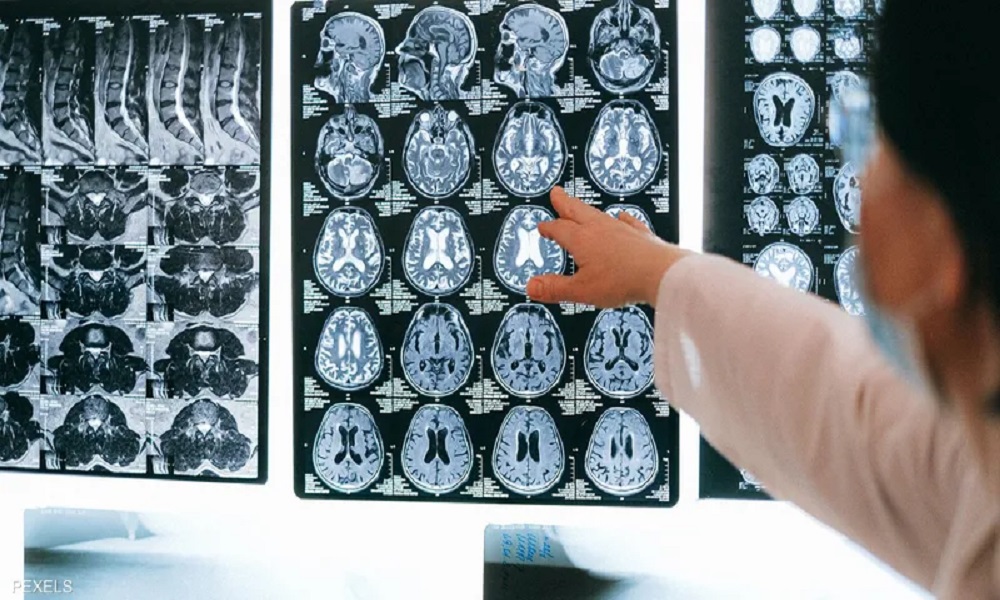 هل تؤثر مرحلة ما بعد كورونا على الدماغ؟