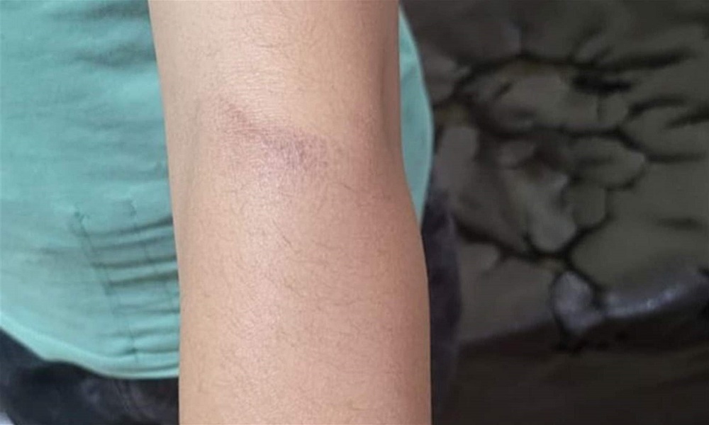 جريمة مروّعة في البقاع… أم تحرق ابنة زوجها بالسكين! (صور)