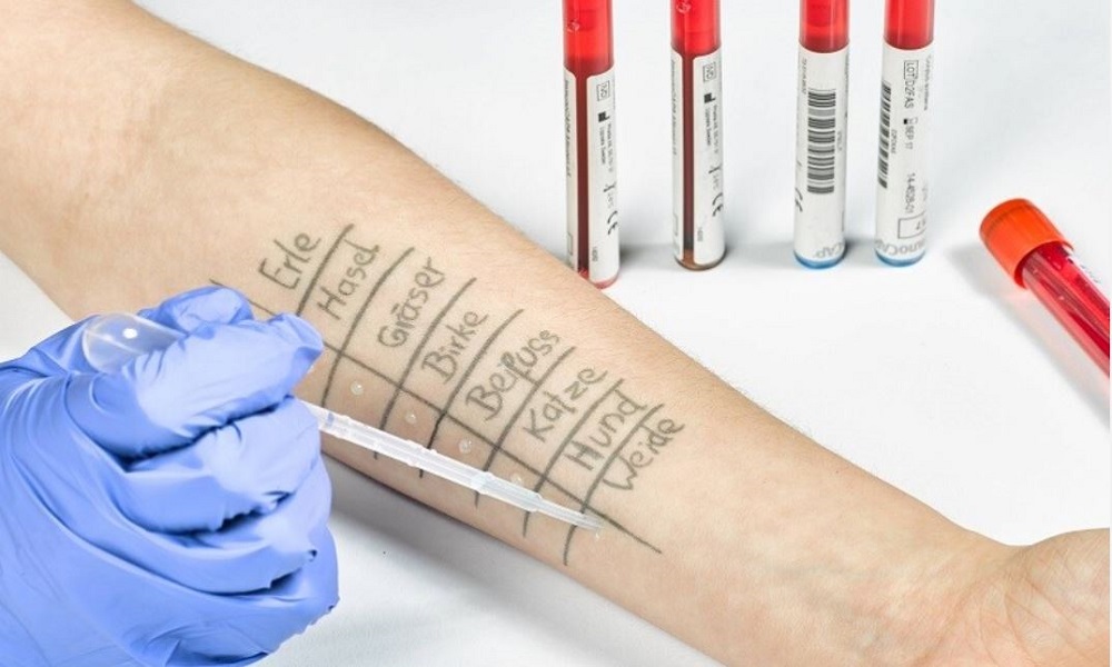 طبيبة تحدد نوع الحساسية غير القابل للعلاج