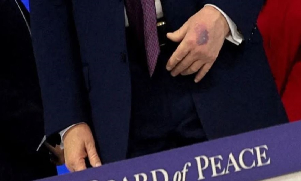 تضارب في رواية “كدمة ترامب”